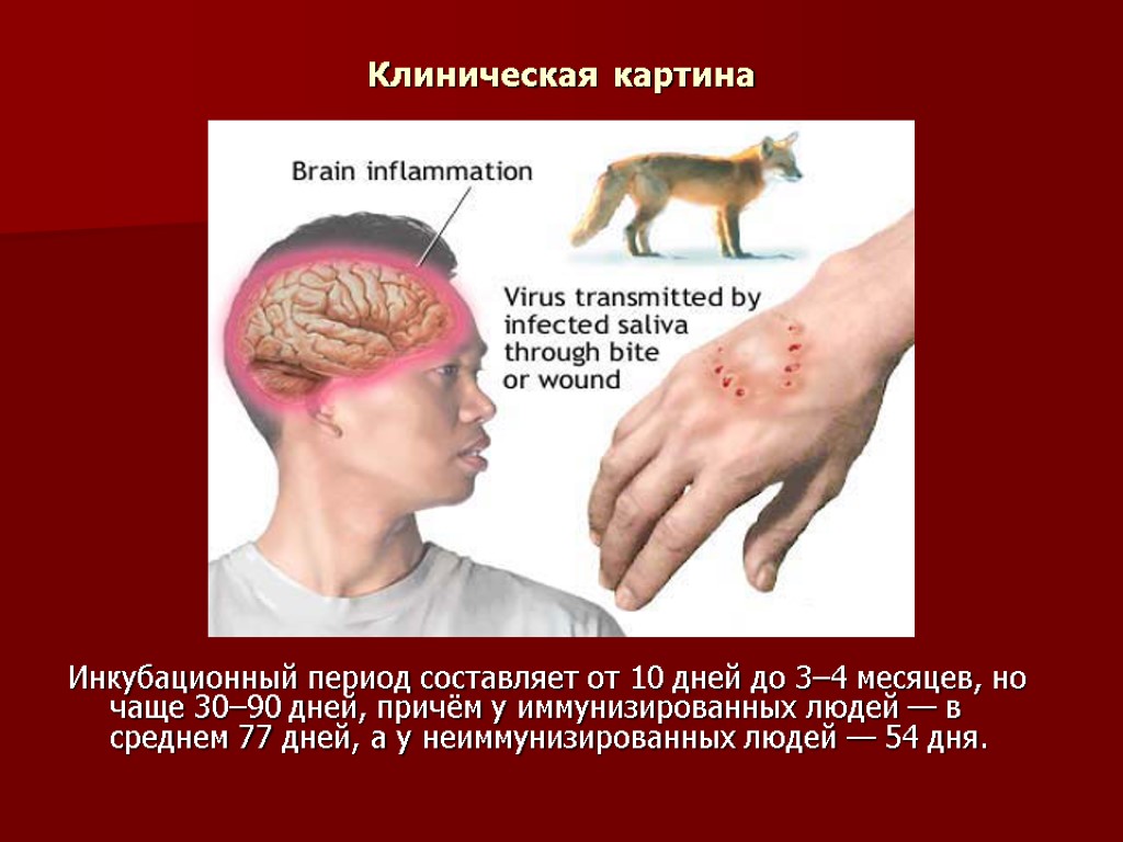 Клиническая картина Инкубационный период составляет от 10 дней до 3–4 месяцев, но чаще 30–90